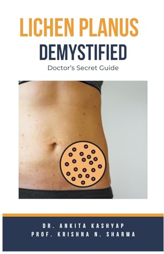 Lichen Planus Demystified Doctors Secret Guide
